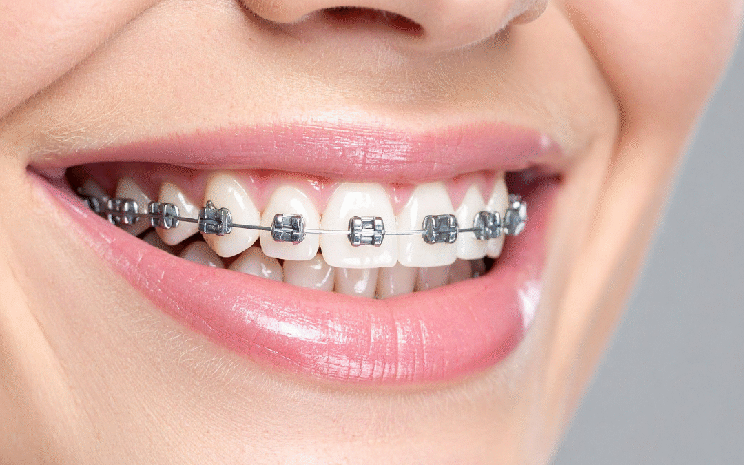 Why Orthodontic Treatment Is The Ultimate Act of Self Love