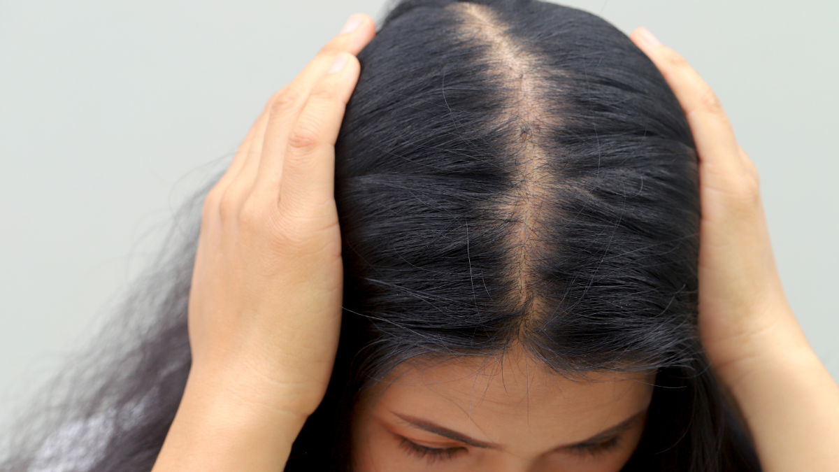 PRP for Men and Women Can It Help with Thinning Hair