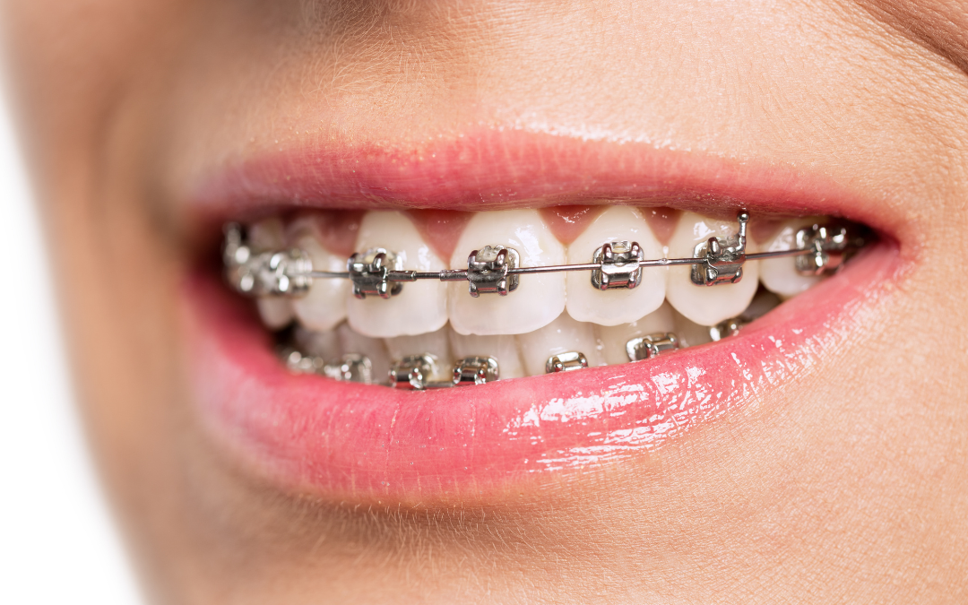 How to Make Braces Less Miserable: A Survival Guide for Teens and Parents