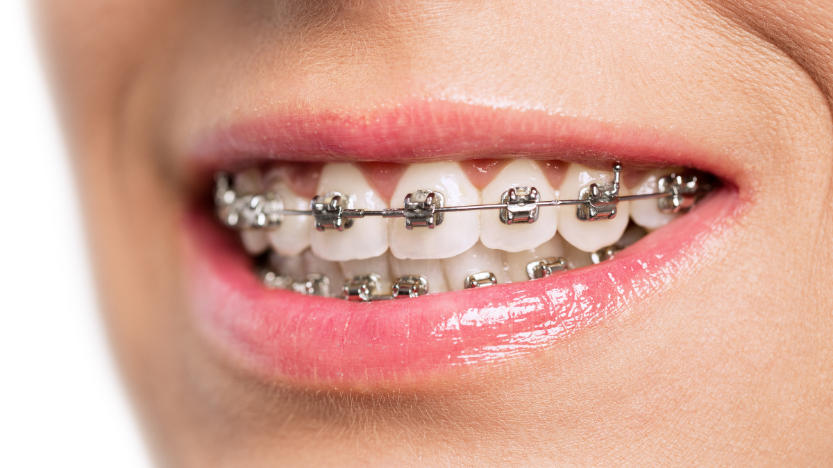How to Make Braces Less Miserable A Survival Guide for Teens and Parents